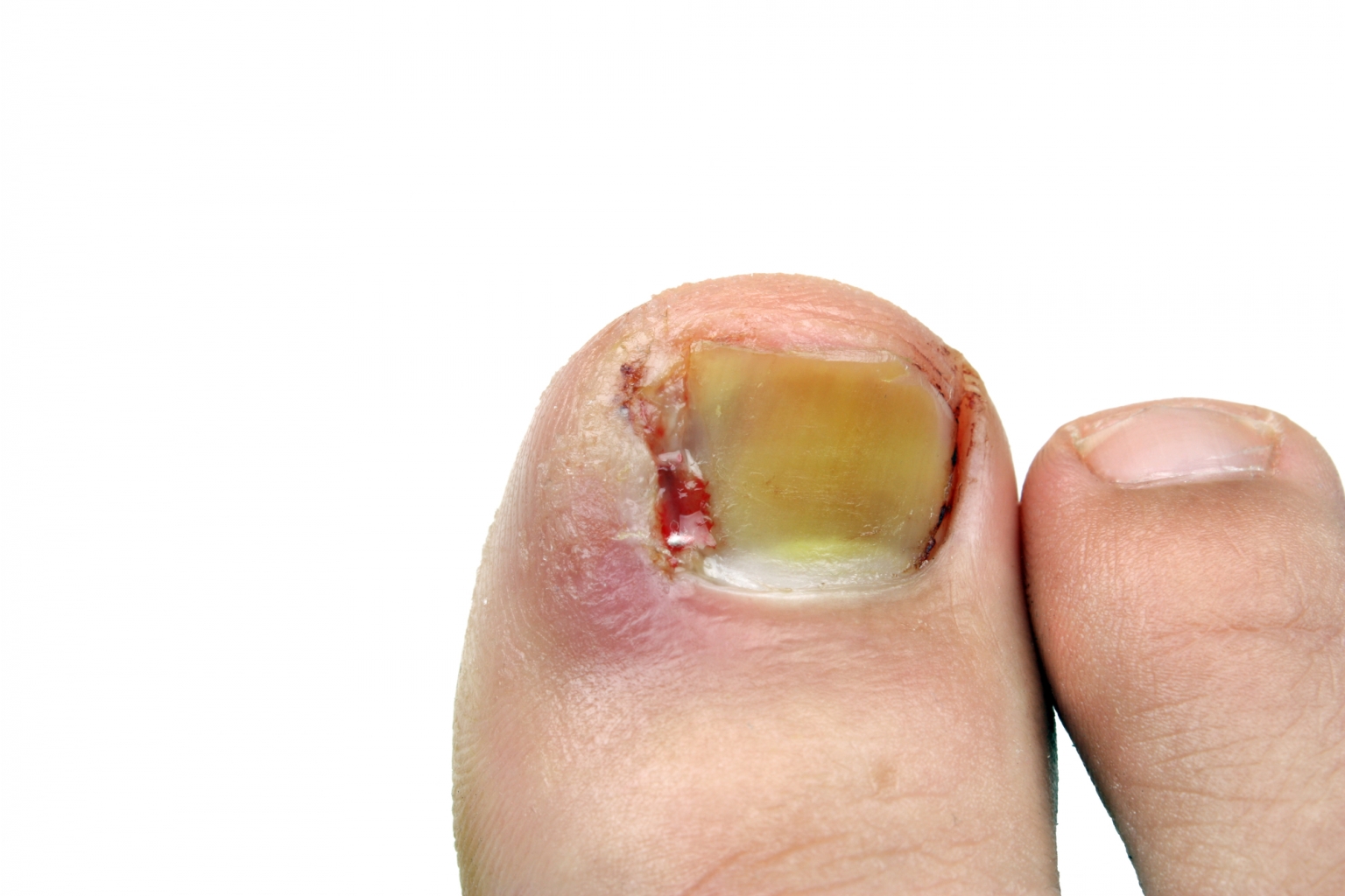 What can be done for an ingrown toenail? 