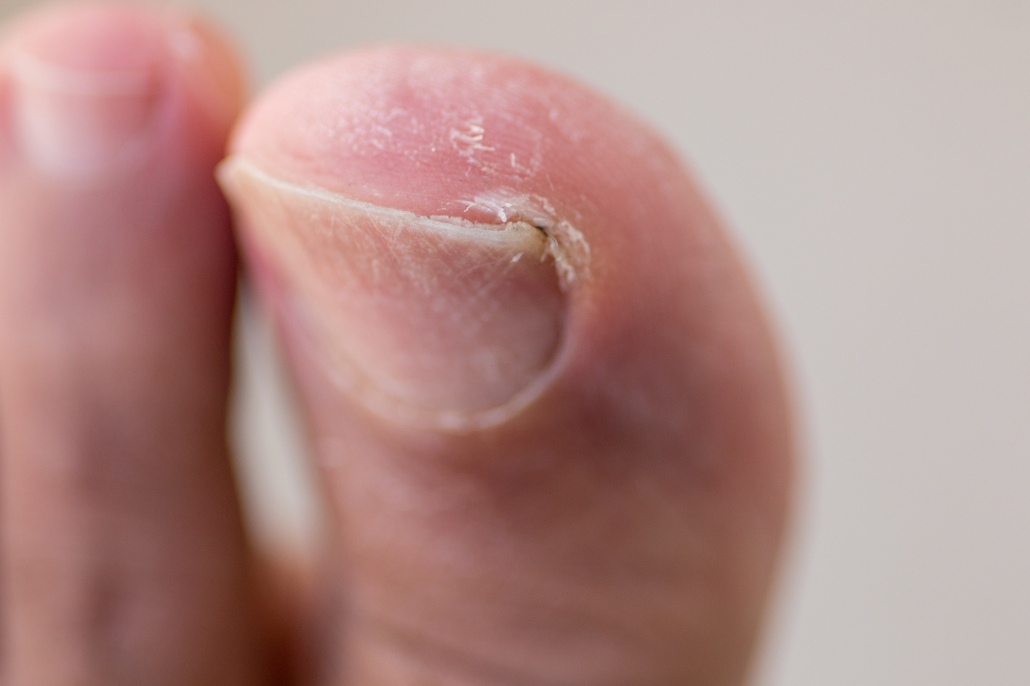 What is an Ingrown Toenail? | CurveCorrect