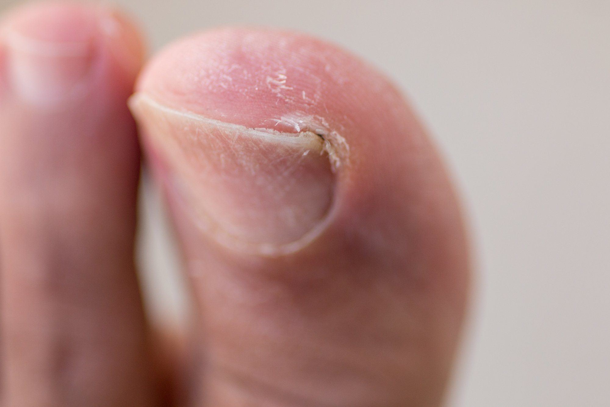 A Permanent Solution for Treating Recurring Ingrown Toenails - YouTube