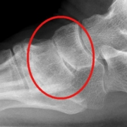 midfoot osteoarthritis
